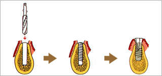 インプラントの埋込手術