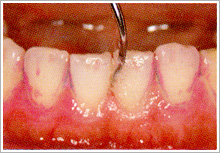 歯こう・歯石の除去